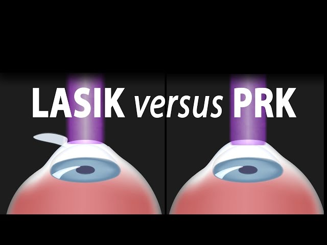 3 Differences Between LASIK and PRK