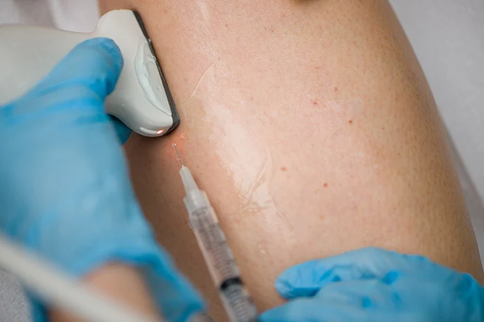 Early Signs and Treatments for Chronic Venous Insufficiency