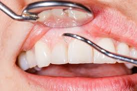 How Gum Disease Can Lead to Systemic Health Issues