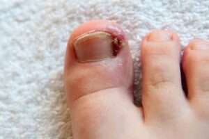 Signs You Might Have an Ingrown Toenail and When to Seek Help