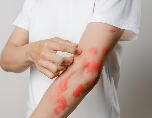 The Impact of Allergies on Your Skin and How to Treat It