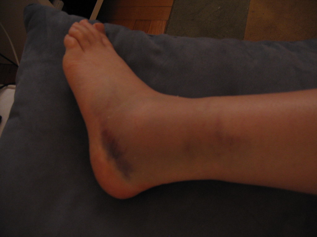 What to Do Immediately After an Ankle Sprain